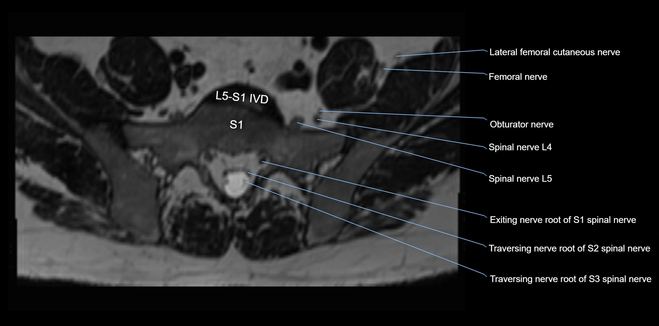 MR lumbosacral plexus axial cross sectional anatomy 3T  radiology  image-img-1008001-00069.webp